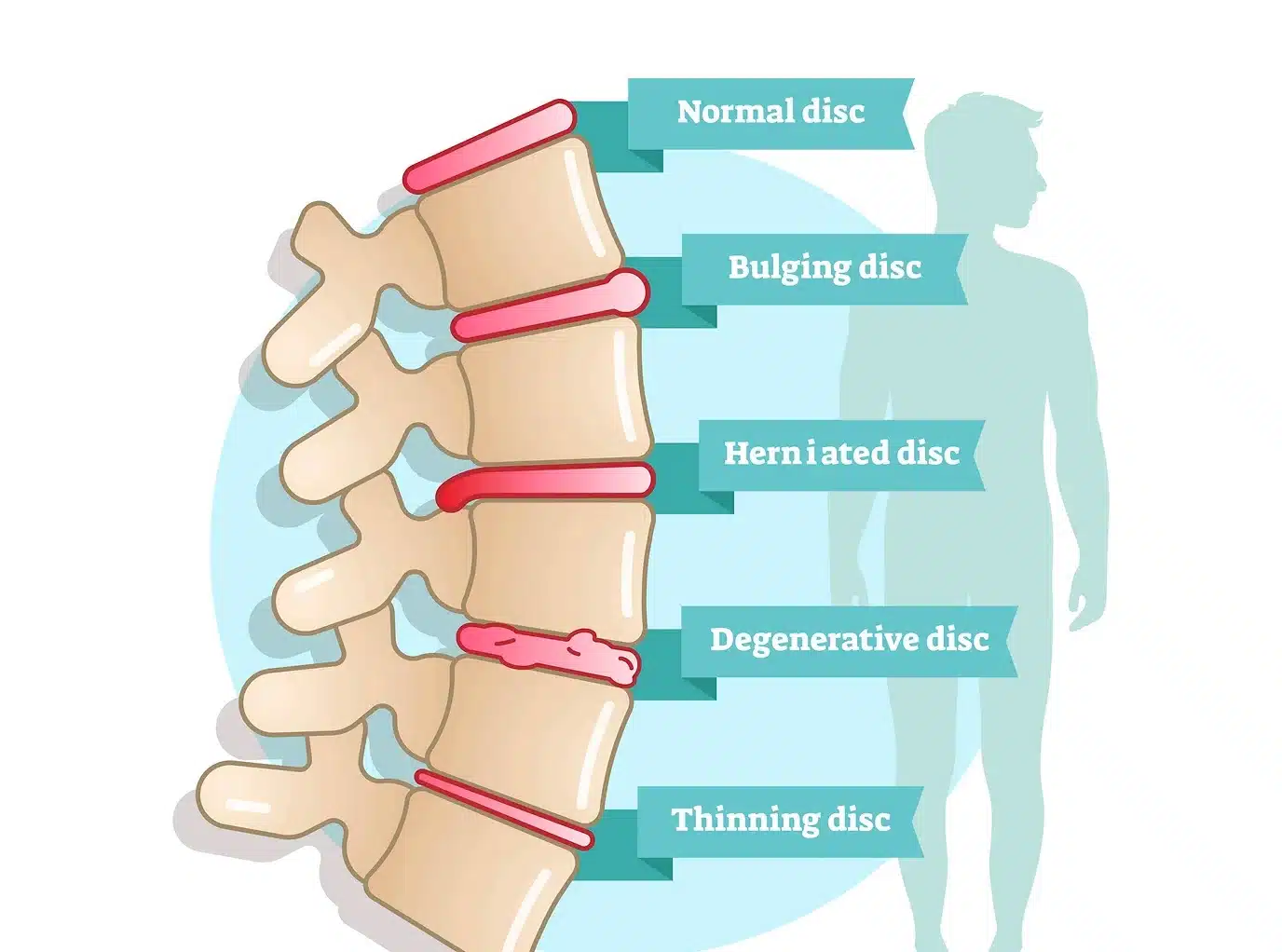 https://www.drauchter.com/wp-content/uploads/2022/11/Herniated-Disc.jpeg.webp