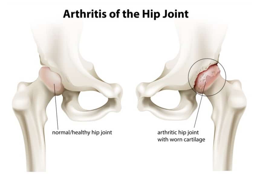 Medical illustration of osteoarthritis on the hip