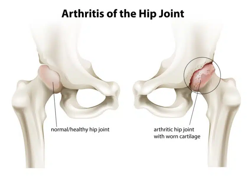 Medical illustration of osteoarthritis on the hip