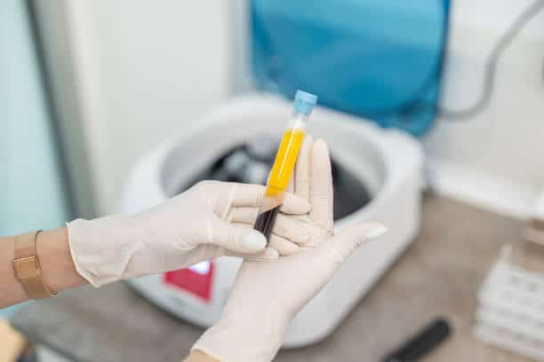 doctor with surgical gloves on holding test tube for prp therapy