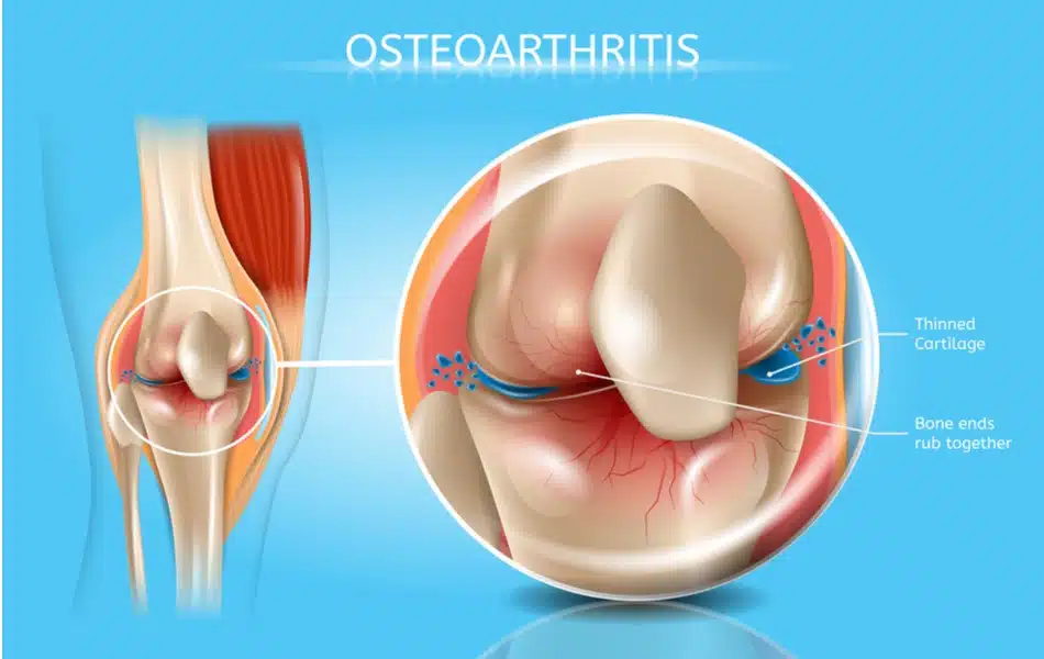 knee osteoarthritis