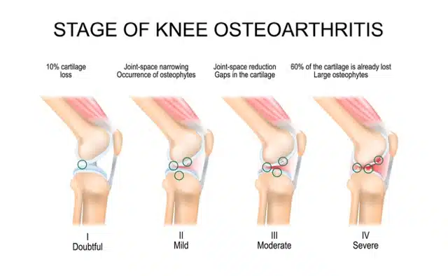 stage of knee osteoarthritis