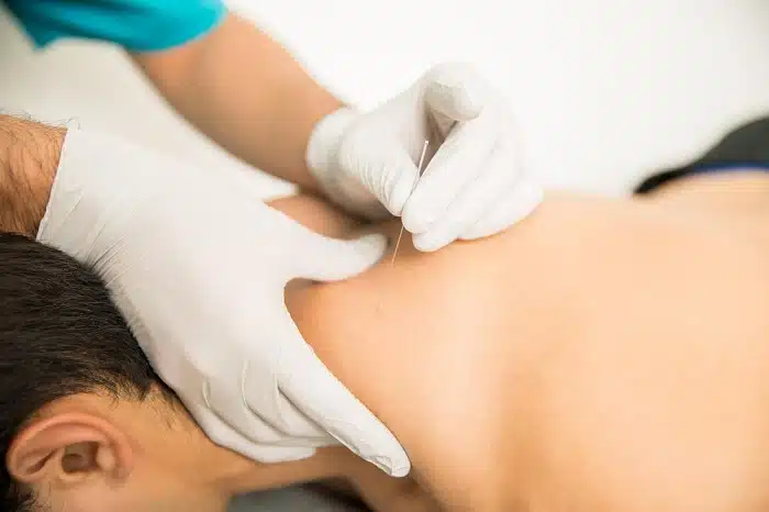 Woman receiving Trigger Point Therapy with Dry Needling for pain relief