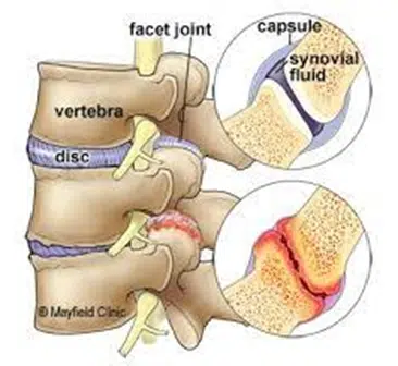 anatomical illustration of spine where the popping sound comes from during chiropractic adjustments 